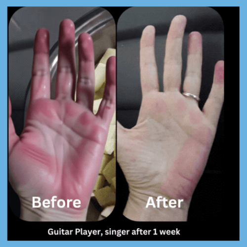 A side-by-side comparison image labeled Before and After showing the physical changes in a guitar player and singer's hand after one week of targeted therapeutic support.